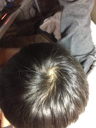 脂溢性脱发吃什么水果 掉头发怎么食补